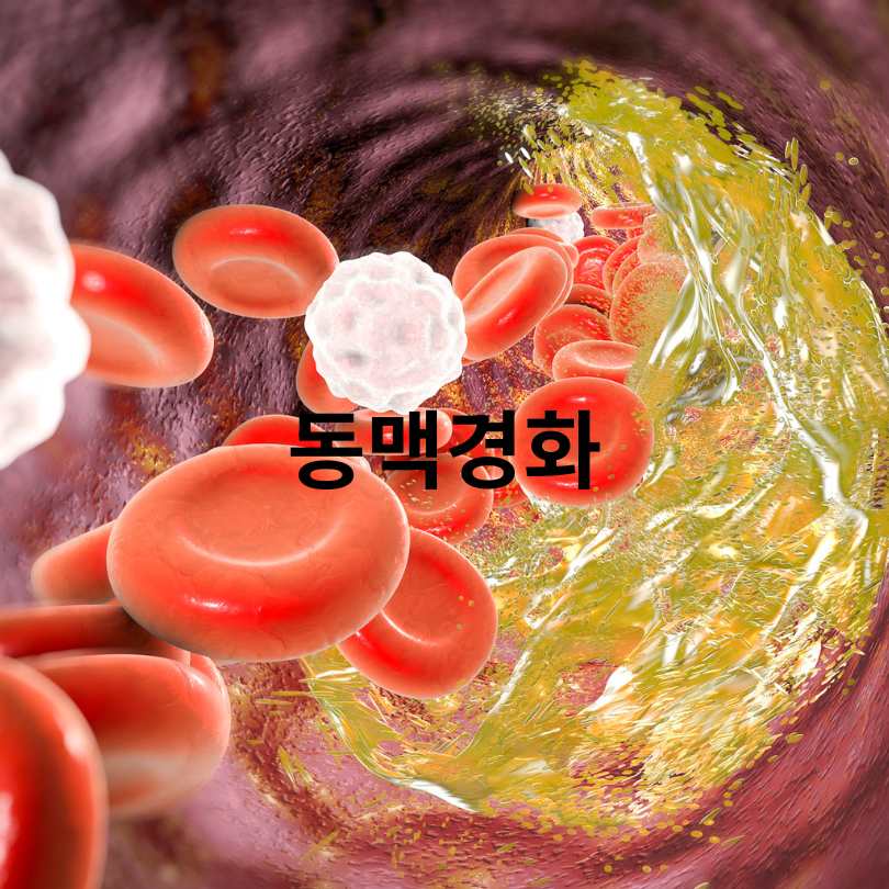 혈관이 막히는 이유? 당신이 몰랐던 진짜 원인들!
