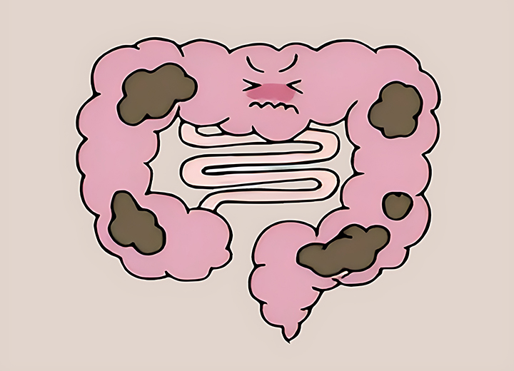 소화-불량과-변비가-생긴-장