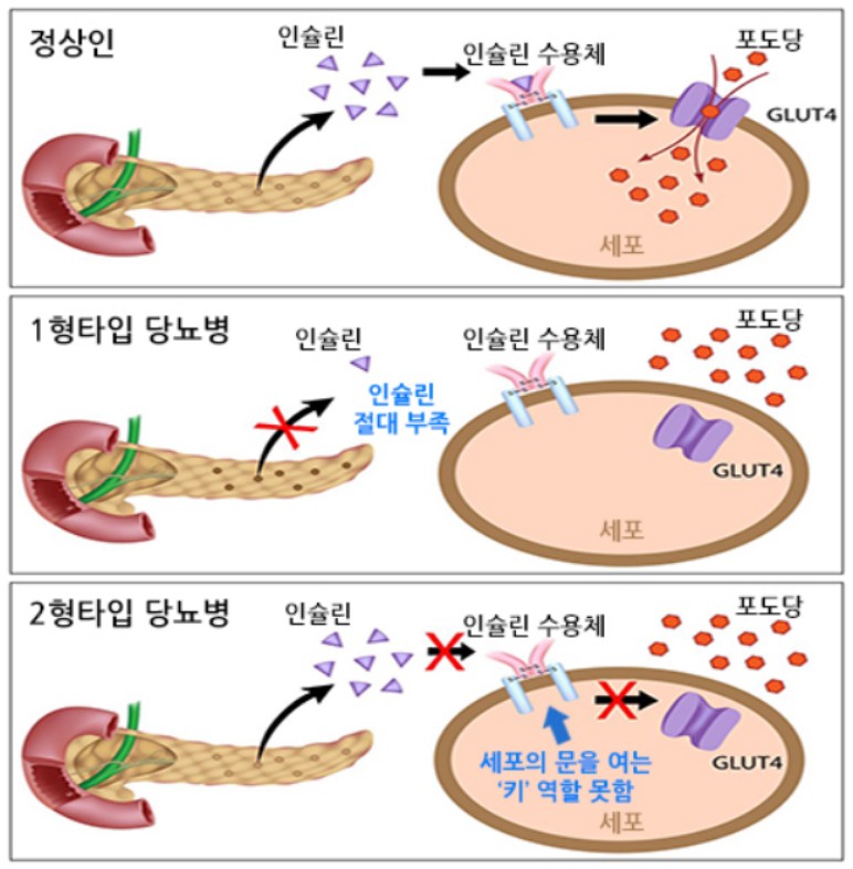 당뇨 초기증상