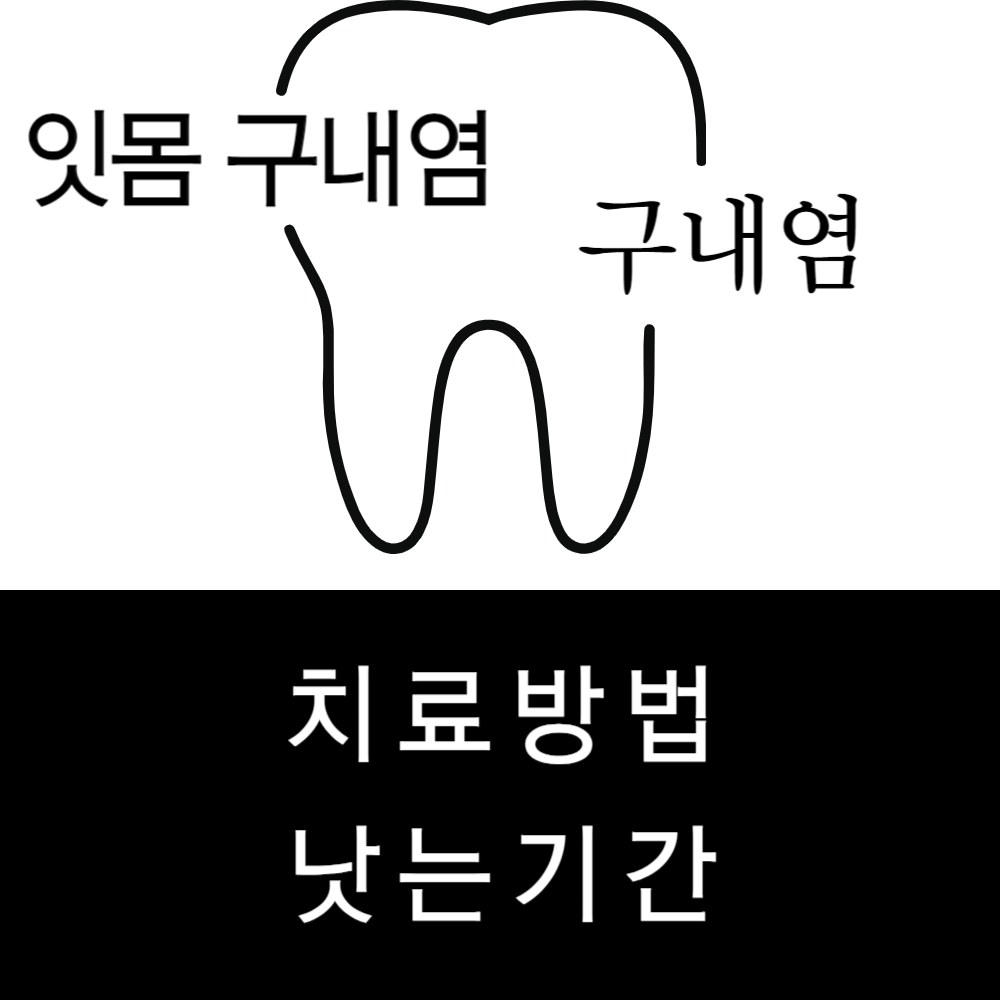 잇몸 구내염, 구내염 치료 방법과 구내염 낫는 기간