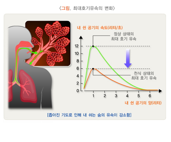 천식 치료