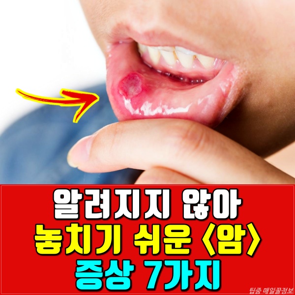 놓치기 쉬운 암 증상 7가지, 구강암 증상 원인, 건강, 팁줌 매일꿀정보