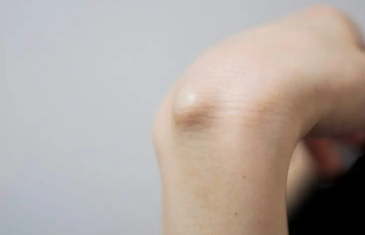 강글리온의 증상