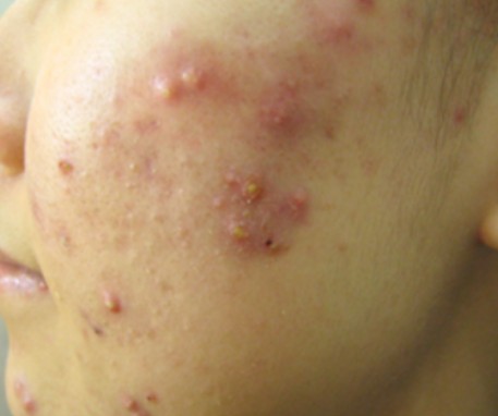 화농성 여드름 증상