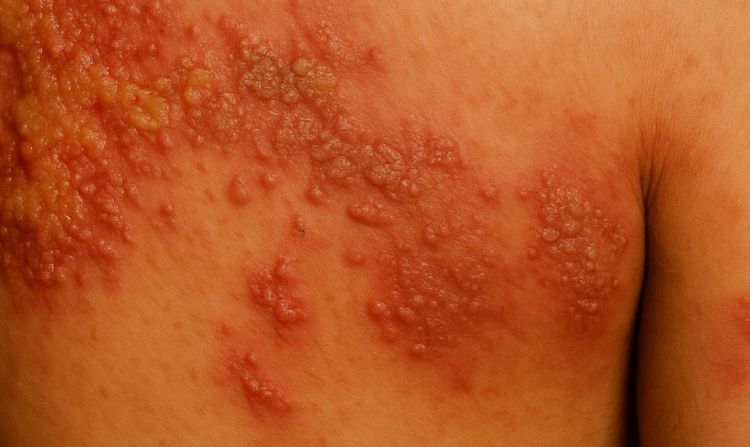 대상포진으로 가슴과 어깨 부위에 붉은 띠 모양으로 퍼진 수포와 발진이 나타난 모습을 표현한 의료 일러스트