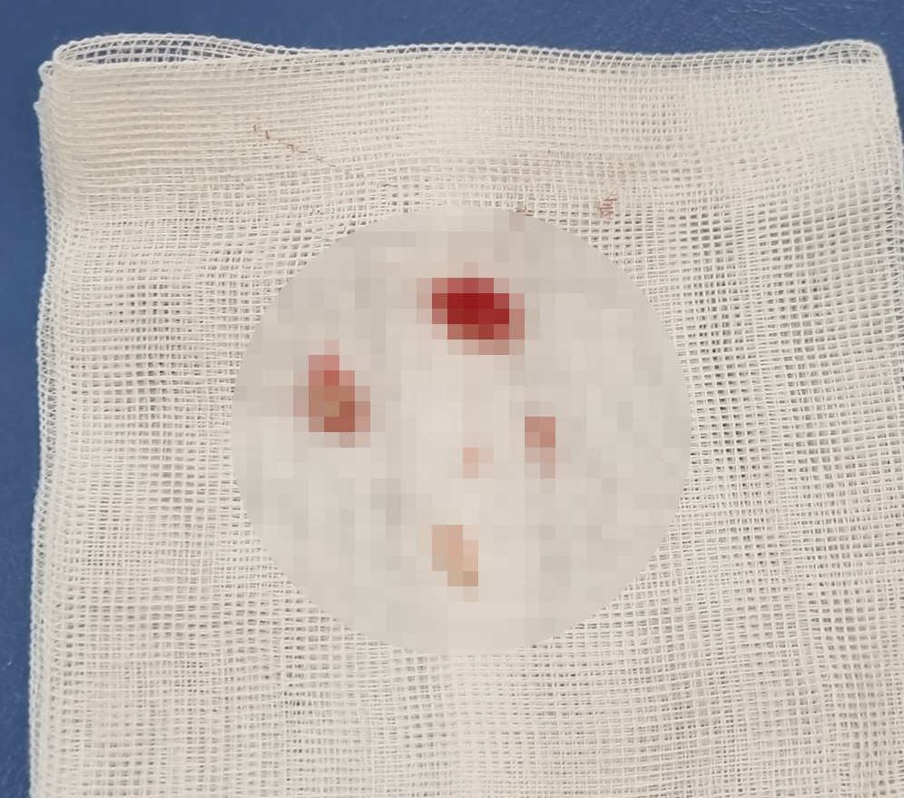 얼굴 피지낭종 제거 후기