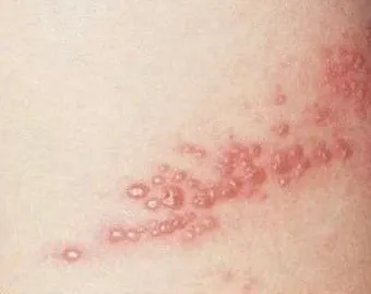 경기도 대상포진 무료접종 연령 기준 정리로 안내_31