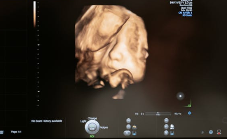 임신 12주차, 1차 기형아 검사