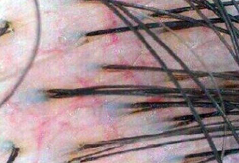 지성 두피 건성 두피 민감성 두피 탈모증상