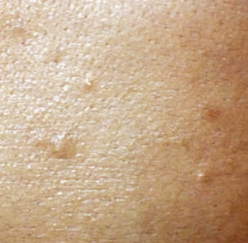 사마귀 원인과 제거방법