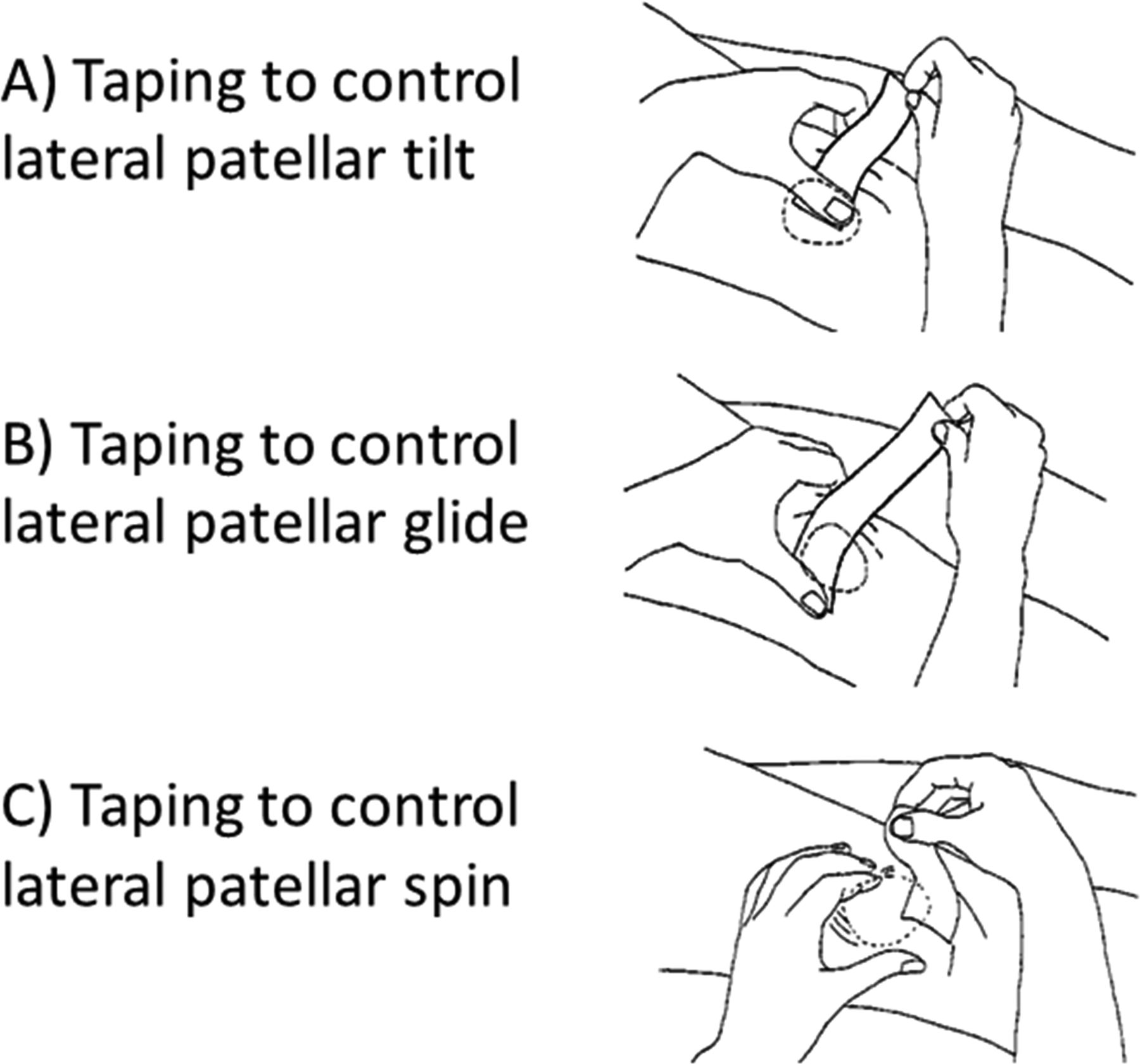 슬개골 테이핑 요법