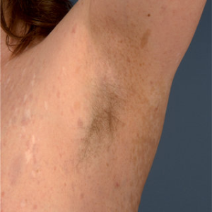 신경섬유종 초기 증상, 혹시 나도? 놓치면 안 되는 신호