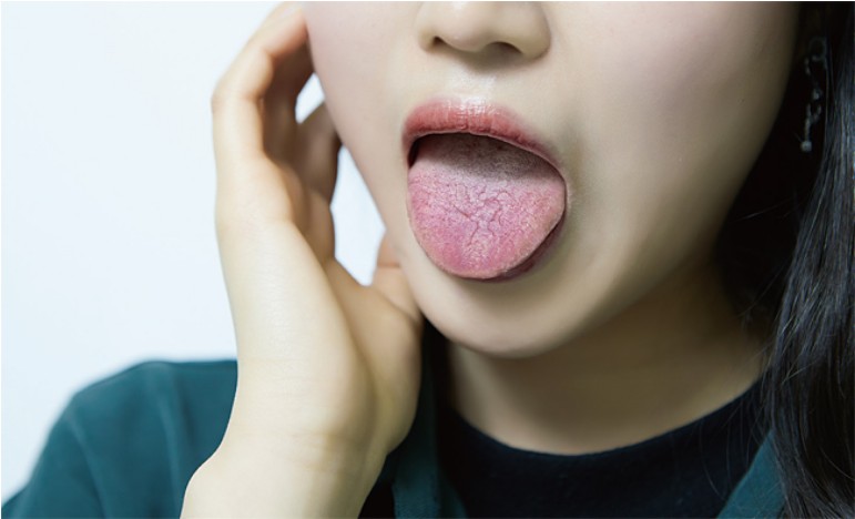 혀끝이-갈라지는-증상