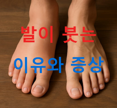발이 붓는 이유와 증상&amp;#44; 발 부종 원인과 차이는?