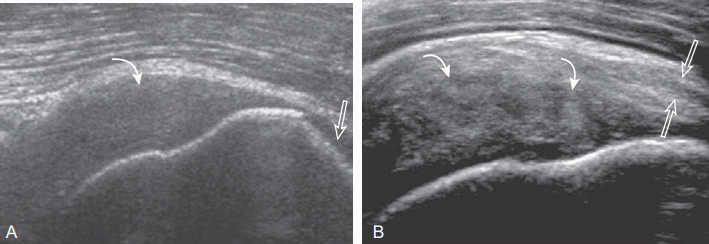 supraspinatus tendinosis : diffuse