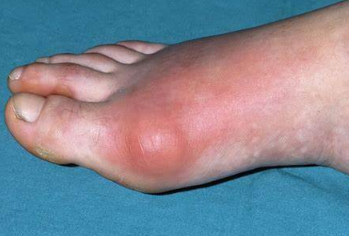 통풍 초기증상4