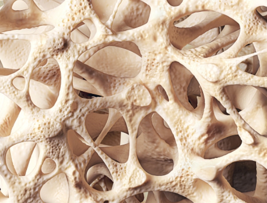 골다공증 뼈