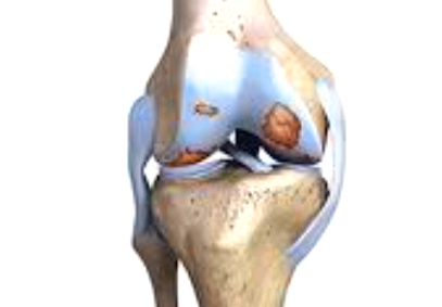 무릎 연골 손상 치료
