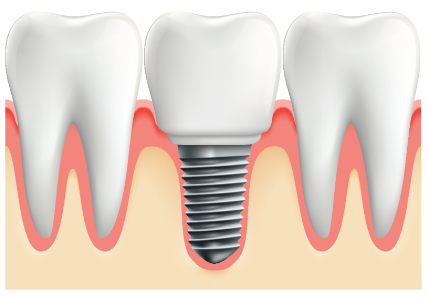 2023년 임플란트 가격