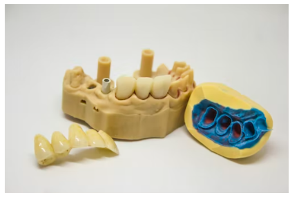 임플란트 장단점