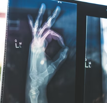 통풍 치료법 진단 기준 합병증