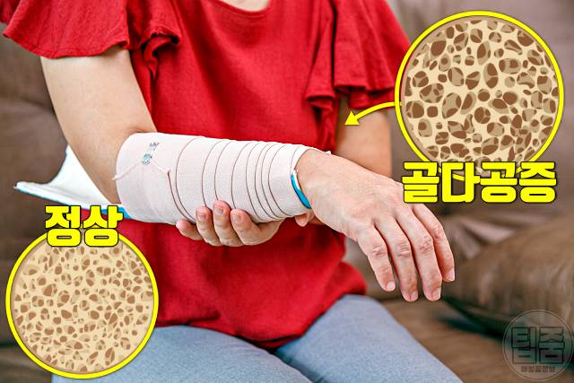 모계유전 질병 골다공증