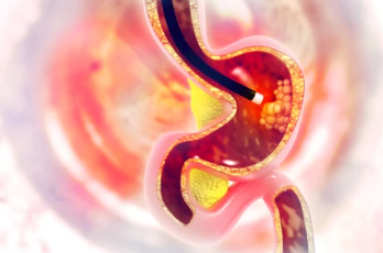 위암 2기 생존율