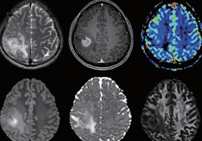 뇌종양 초기증상 10가지 총정리 섬네일