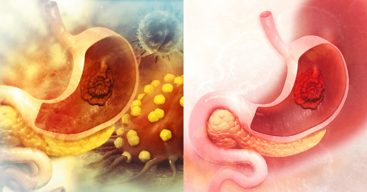 위와 박테리아 또는 위염