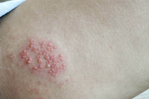 대상포진 초기증상 대표 6가지 및 통증&amp;#44; 치료방법에 대해 알아봤습니다. 대상포진이 걸리면 무엇보다 통증이 심해서 매우 힘들어하는데요~ 그래서 하루빨리 증상이 나타나면 병원에 가야 합니다! 증상을 확인해보세요~