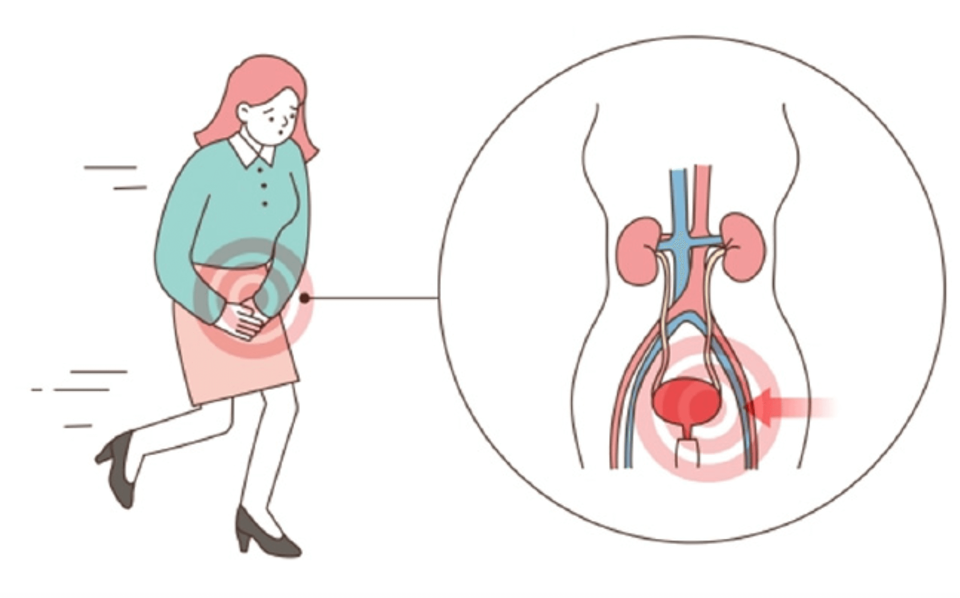 방광염 초기증상