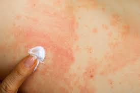 피부발진의 종류