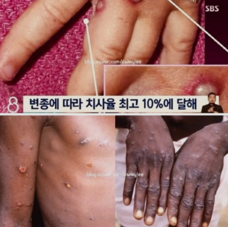 원숭이 두창