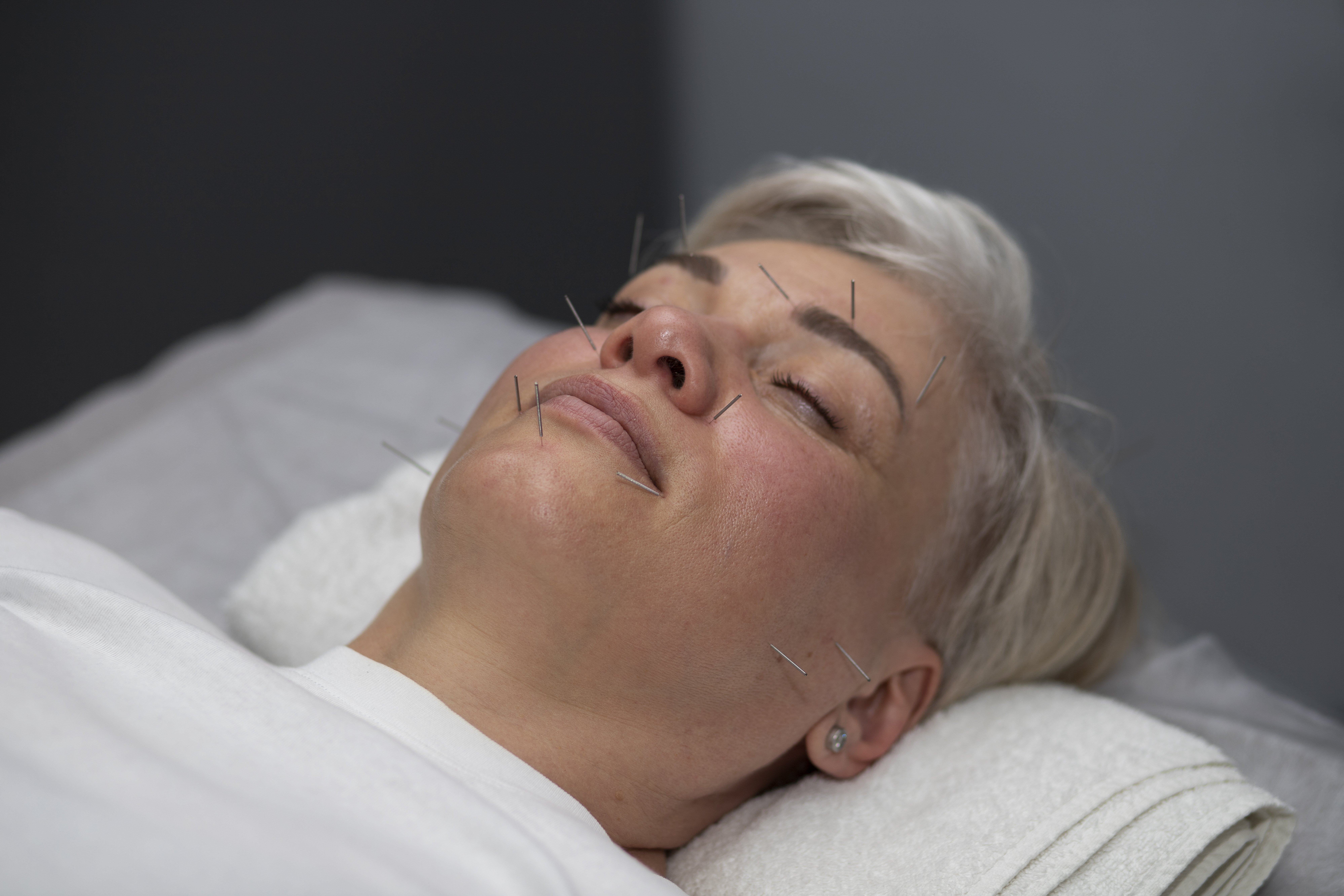 우울증이 있는 여자 환자에게&#44; 우울증을 치료하기 위해서&#44; 누워서 베개를 베고 있는 여성의 얼굴에 침시술을 해 놓은 사진