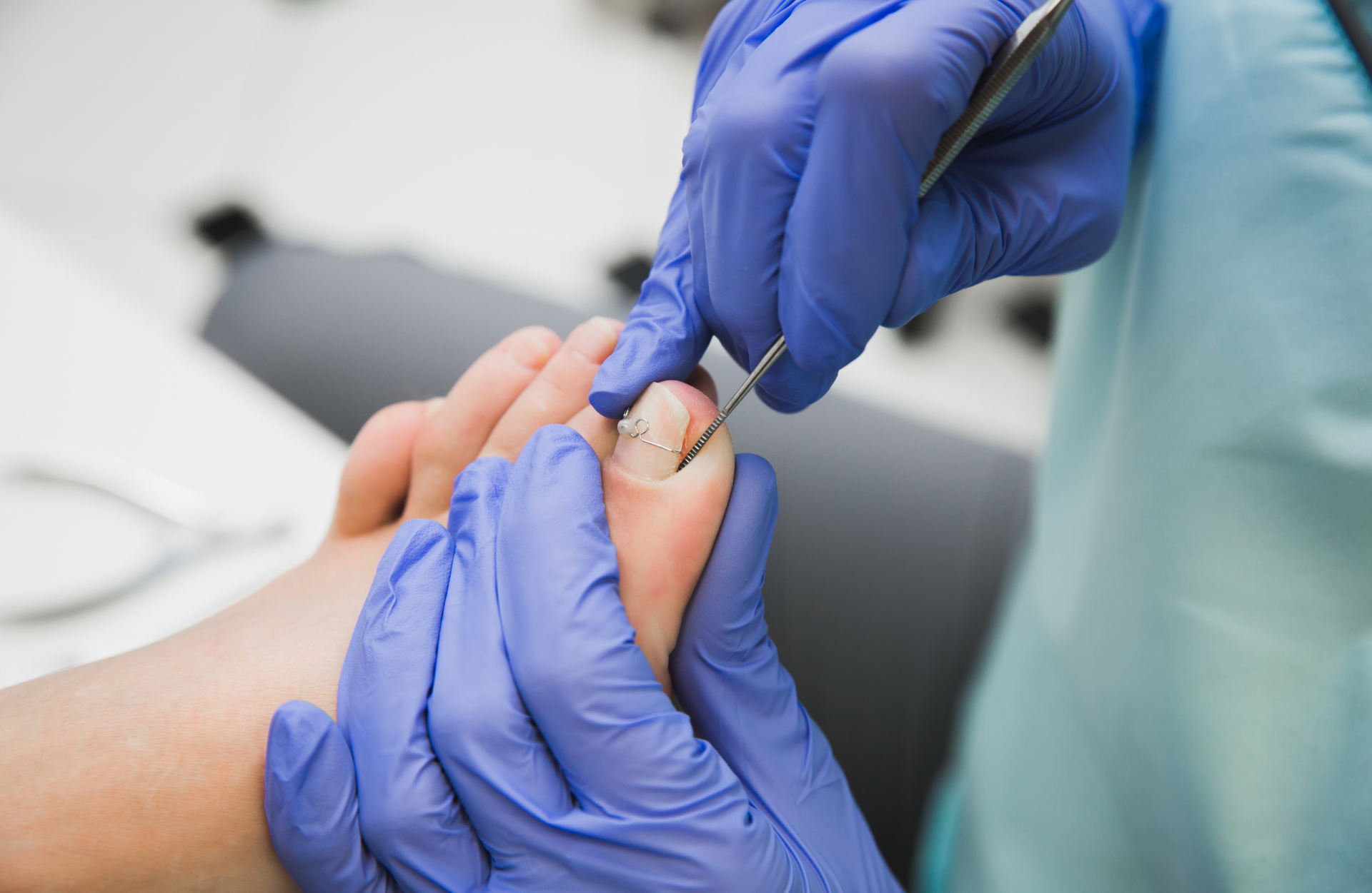 발톱무좀 예방법