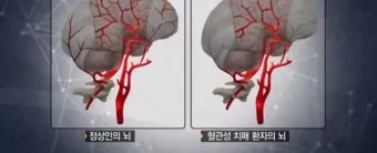 혈관성치매 원인 증상 치료법과 예방 생활습관_5