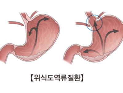 역류성 식도염 입냄새