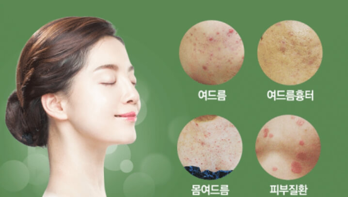 여드름
