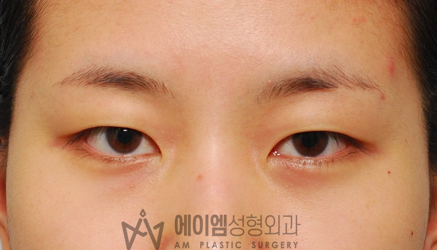 수술 전 정면 (절개법)