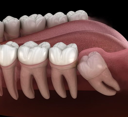 사랑니 발치 방법, 사랑니 통증, 사랑니 발치 후 후유증 합병증, 사랑니 발치 후 주의사항