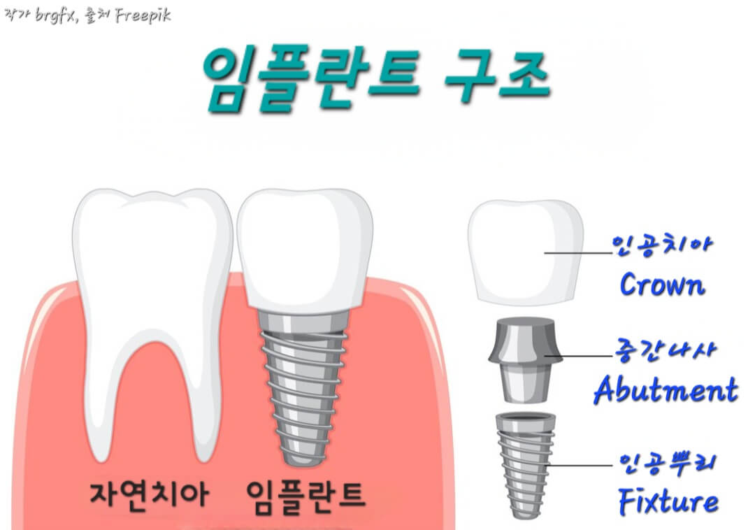 임플란트구조
