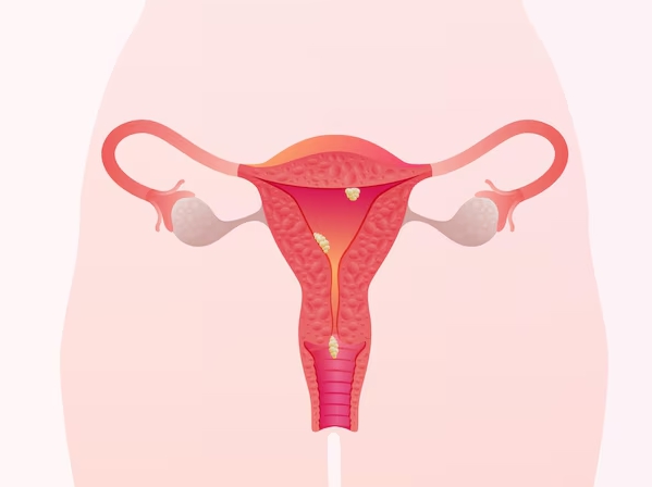 여성 생식기 질환