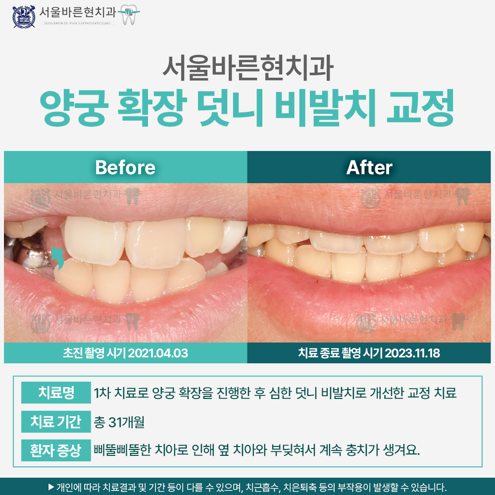 마린시티치아교정