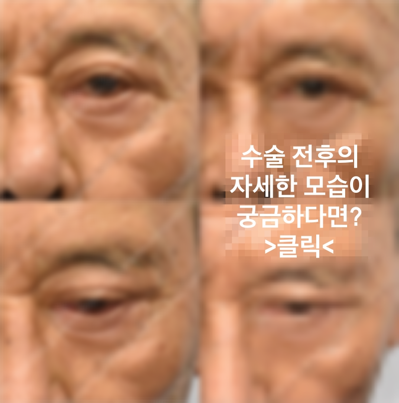 안검외반-치료