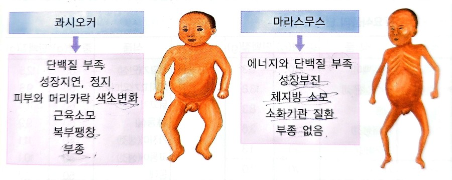 콰시오커와 마라스무스