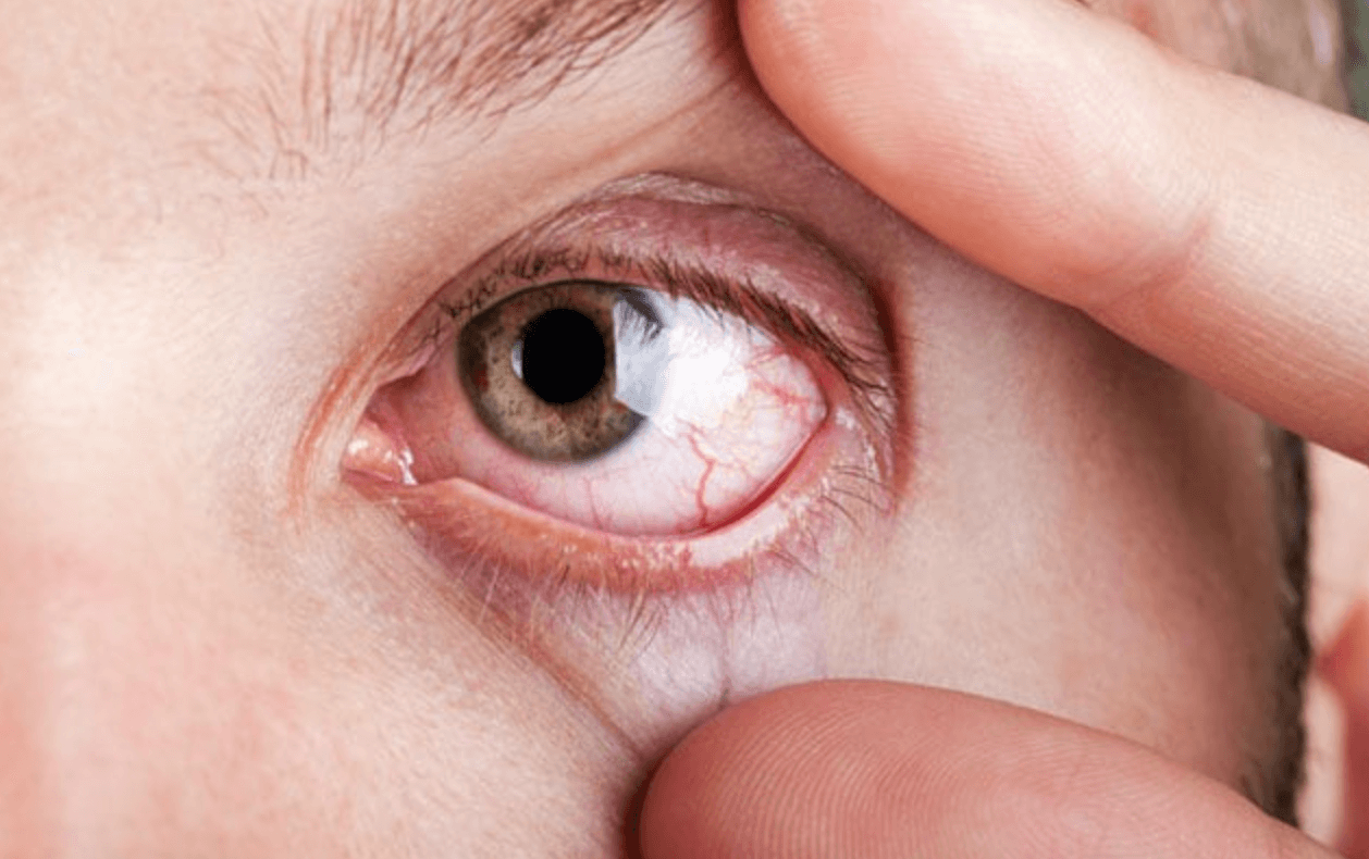 안구-건조증-증상