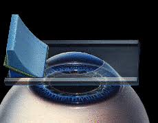 라식과 라섹 차이점