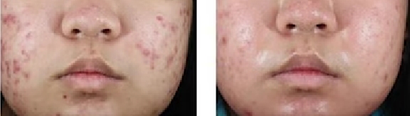 아클리프-크림으로-여드름-없애는-방법