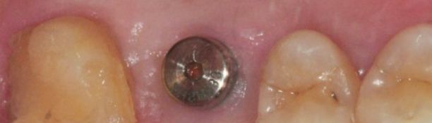 임플란트 식립 후 잇몸 밖으로 노출되는 부분