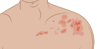 대상포진 초기증상 치료방법 예방법 총정리